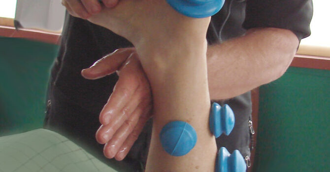 Cupping Therapy