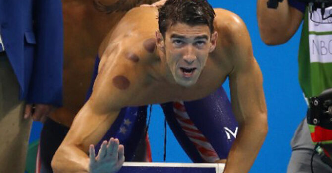 Cupping Therapy: What You Should Know